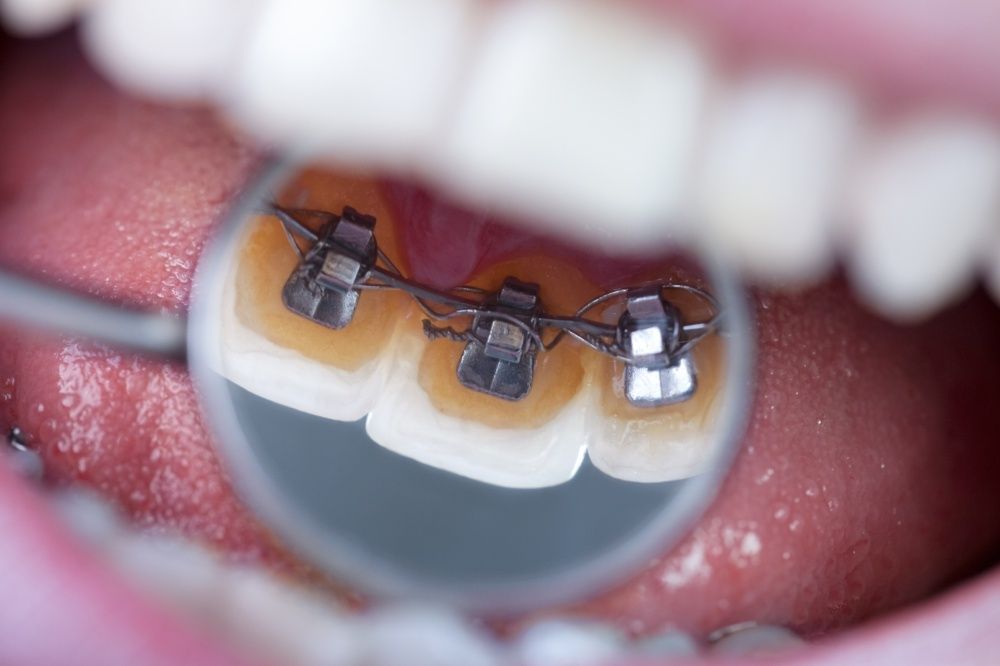 Dentists Helping Teens Understand Braces with Inbound Marketing